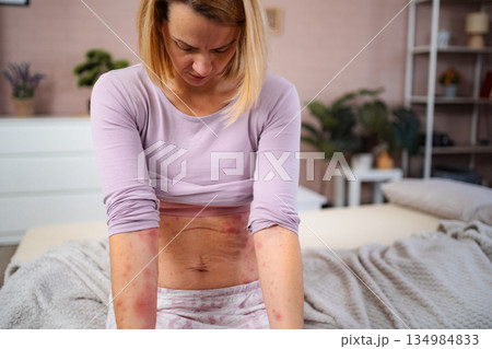 Woman suffering from skin rash allergy on body at home 134984833