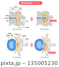 腰椎椎間板ヘルニア　椎間板の構造　腰痛 135005230