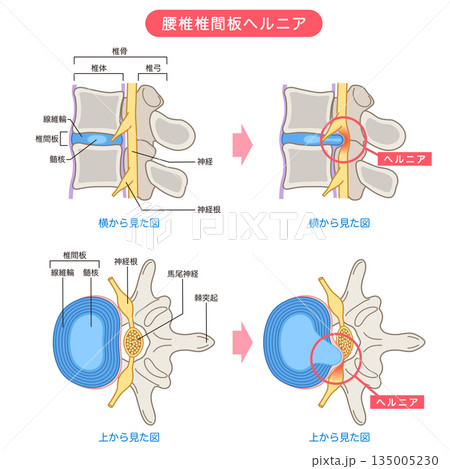 腰椎椎間板ヘルニア　椎間板の構造　腰痛 135005230