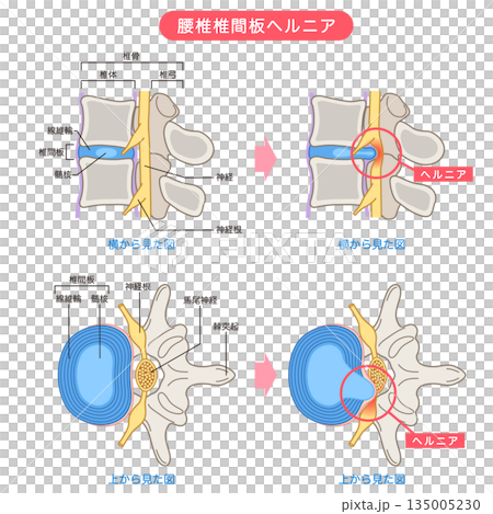 腰椎間盤突出、椎間盤結構、下背痛 135005230