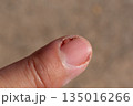 Acute Paronychia Infection on Fingernail Close-Up 135016266