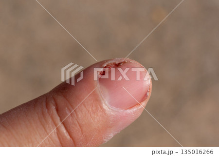 Acute Paronychia Infection on Fingernail Close-Up 135016266