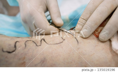 The process of surgery to eliminate varicose veins on the leg. The male hands of a doctor do an operation on the veins, on the patient's leg. Preparation of the patient for radiofrequency ablation of 135019196