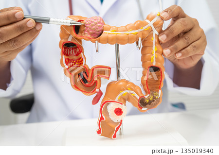 Colorectal cancer, doctor holding intestine colon human anatomy model. 135019340