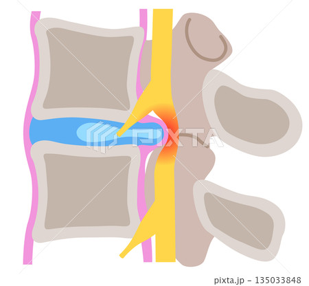 腰椎椎間板ヘルニア　椎間板の構造　腰痛 135033848