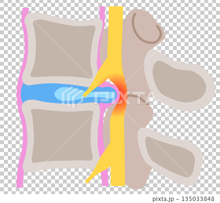 腰椎椎間板ヘルニア　椎間板の構造　腰痛 135033848