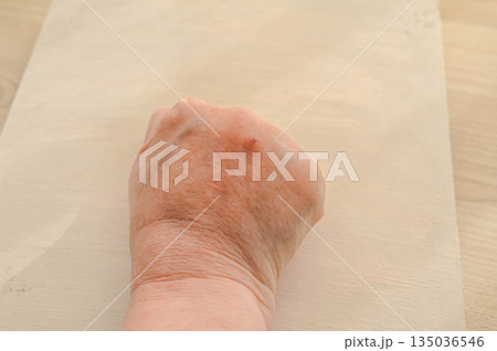 ペットのネコに噛まれてパンパンに腫れた拳 135036546