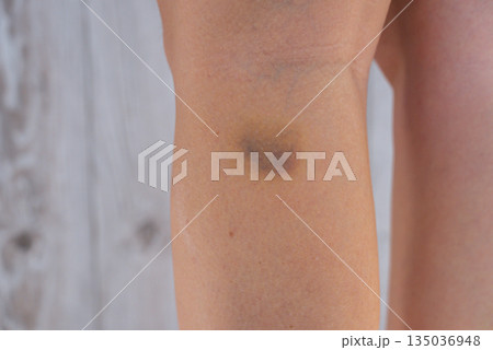 Unrecognized person with bruises on body at home scene. Close-up of woman with bruised leg. Bruising leg area, injury accident. Concept of home abuse. Consequences 135036948