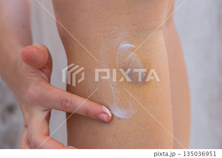 Unrecognized person rubbing recovery healing cream bruises on body at home scene. Close-up of woman with bruised leg. Bruising leg area, injury accident. Concept of home abuse. Consequences 135036951