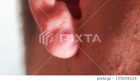 Swollen ear with redness, indicating potential skin irritation or infection near the ear area, red pimple Swollen ear with redness, indicating potential skin irritation or infection near the ear area, red pimple 135039329