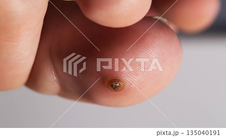 Close View Of A Circular Verruca On A Toe. The Macro Lens Captures The Wart's Details. 135040191