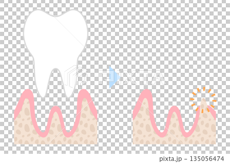 拔牙後牙槽骨邊緣 135056474