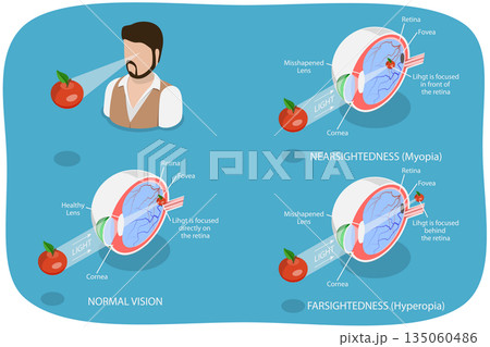 3D Isometric Flat  Illustration of Vision Disorder, Far-Sightedness And Near-Sightedness Anatomical Diagram 135060486