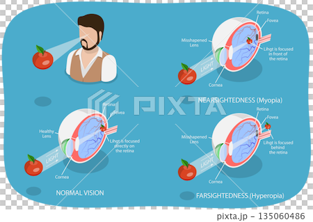 3D Isometric Flat  Illustration of Vision Disorder, Far-Sightedness And Near-Sightedness Anatomical Diagram 135060486