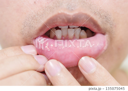 Mouth Ulcer Sore or Aphthous Stomatitis. Oral Health and Medical concepts 135075045