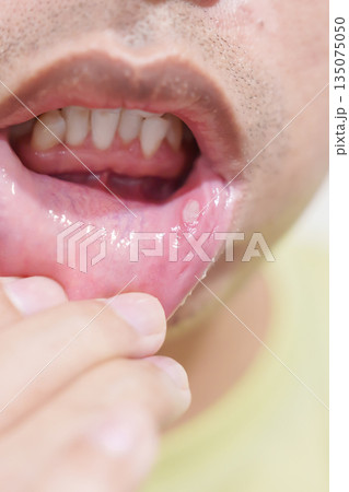 Mouth Ulcer Sore or Aphthous Stomatitis. Oral Health and Medical concepts 135075050