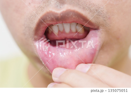 Mouth Ulcer Sore or Aphthous Stomatitis. Oral Health and Medical concepts Mouth Ulcer Sore or Aphthous Stomatitis. Oral Health and Medical concepts 135075051
