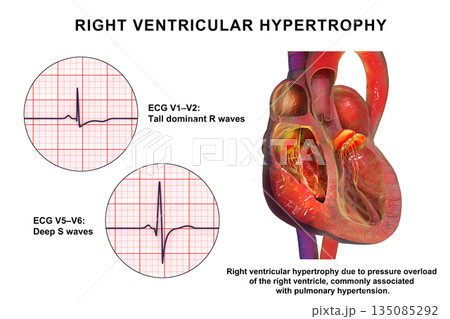 Right ventricular hypertrophy, 3D illustration showing thickened right ventricular myocardium with ECG examples in leads V1-V2 and V5-V6 demonstrating characteristic voltage changes. Right ventricular hypertrophy, 3D illustration showing thickened right ventricular myocardium with ECG examples in leads V1-V2 and V5-V6 demonstrating characteristic voltage changes. 135085292