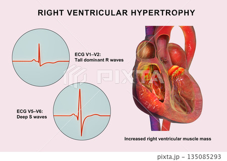 Right ventricular hypertrophy, 3D illustration showing thickened right ventricular myocardium with ECG examples in leads V1-V2 and V5-V6 demonstrating characteristic voltage changes. Right ventricular hypertrophy, 3D illustration showing thickened right ventricular myocardium with ECG examples in leads V1-V2 and V5-V6 demonstrating characteristic voltage changes. 135085293