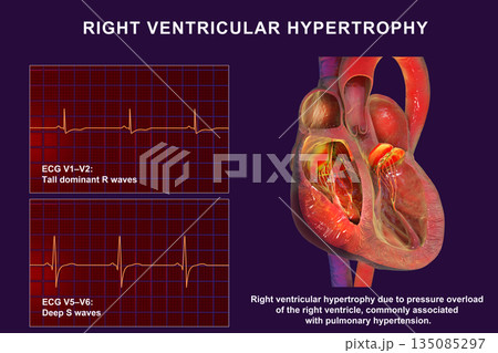 Right ventricular hypertrophy, 3D illustration showing thickened right ventricular myocardium with ECG examples in leads V1-V2 and V5-V6 demonstrating characteristic voltage changes. Right ventricular hypertrophy, 3D illustration showing thickened right ventricular myocardium with ECG examples in leads V1-V2 and V5-V6 demonstrating characteristic voltage changes. 135085297