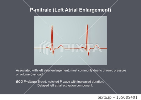 P-mitrale, 3D illustration P-mitrale, 3D illustration 135085401