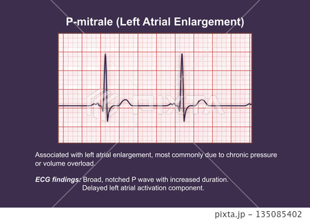 P-mitrale, 3D illustration P-mitrale, 3D illustration 135085402