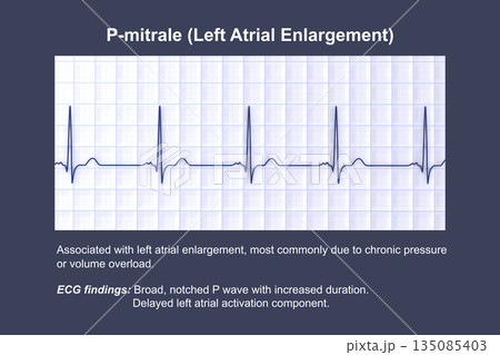 P-mitrale, 3D illustration 135085403