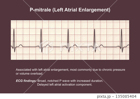 P-mitrale, 3D illustration 135085404