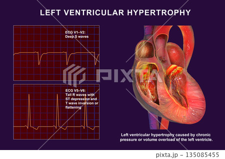 Left ventricular hypertrophy, 3D illustration showing thickened left ventricular myocardium with ECG examples in leads V1-V2 and V5-V6 demonstrating voltage changes Left ventricular hypertrophy, 3D illustration showing thickened left ventricular myocardium with ECG examples in leads V1-V2 and V5-V6 demonstrating voltage changes 135085455