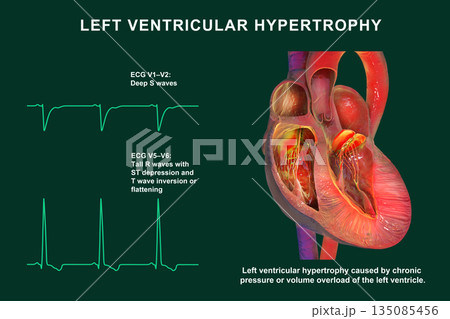 Left ventricular hypertrophy, 3D illustration showing thickened left ventricular myocardium with ECG examples in leads V1-V2 and V5-V6 demonstrating voltage changes 135085456