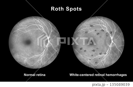 Roth spots, illustration Roth spots, illustration 135089039