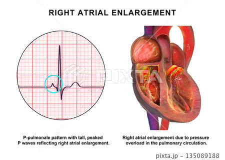 Right atrial enlargement with P-pulmonale, 3D illustration Right atrial enlargement with P-pulmonale, 3D illustration 135089188