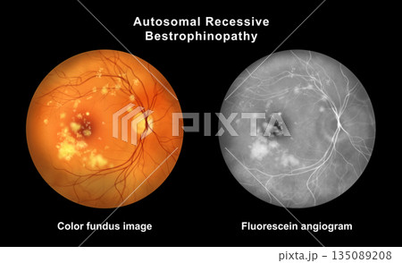 Autosomal recessive bestrophinopathy, illustration Autosomal recessive bestrophinopathy, illustration 135089208