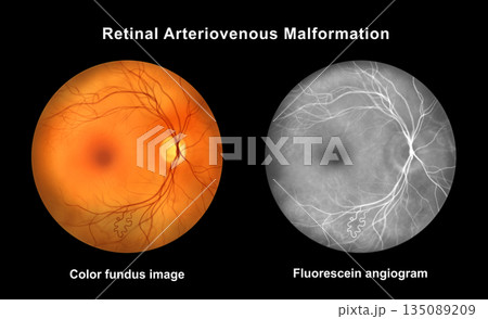 Retinal arteriovenous malformation, illustration Retinal arteriovenous malformation, illustration 135089209