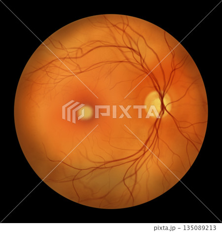 Best disease stage 2, illustration Best disease stage 2, illustration 135089213