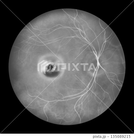 Best disease stage 3, illustration Best disease stage 3, illustration 135089215