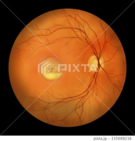 Best disease stage 3, illustration Best disease stage 3, illustration 135089216
