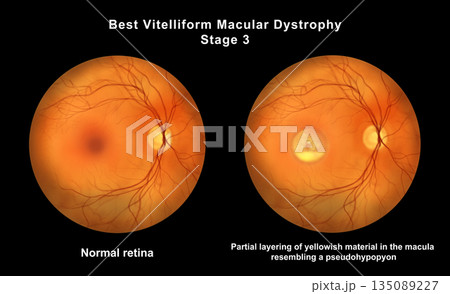 Retina with microaneurysms, illustration Retina with microaneurysms, illustration 135089227