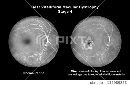 Retina with microaneurysms, illustration Retina with microaneurysms, illustration 135089228