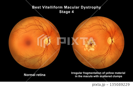 Retina with microaneurysms, illustration Retina with microaneurysms, illustration 135089229