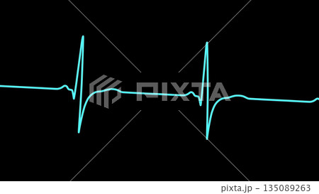 Right ventricular hypertrophy, 3D illustration 135089263