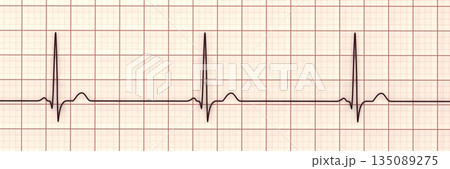 Sinus bradycardia, 3D illustration Sinus bradycardia, 3D illustration 135089275