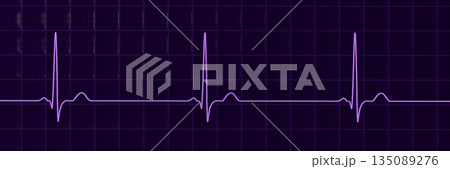 Sinus bradycardia, 3D illustration 135089276