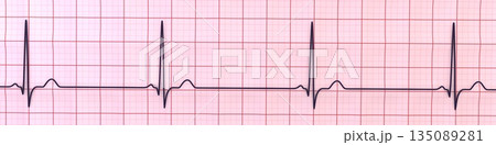 Sinus bradycardia, 3D illustration Sinus bradycardia, 3D illustration 135089281