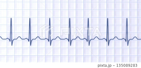 Sinus tachycardia, 3D illustration Sinus tachycardia, 3D illustration 135089283