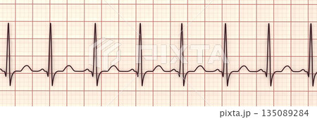 Sinus tachycardia, 3D illustration 135089284