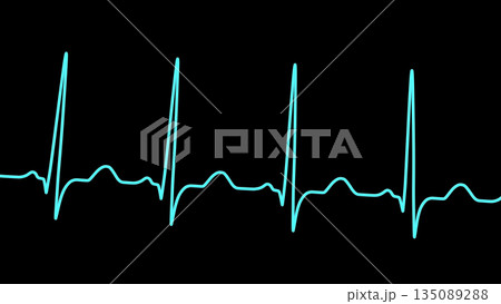 Sinus tachycardia, 3D illustration Sinus tachycardia, 3D illustration 135089288