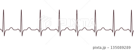 Sinus tachycardia, 3D illustration Sinus tachycardia, 3D illustration 135089289