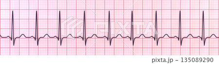 Sinus tachycardia, 3D illustration Sinus tachycardia, 3D illustration 135089290