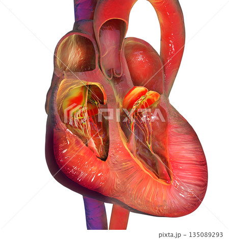 Biventricular hypertrophy, 3D illustration Biventricular hypertrophy, 3D illustration 135089293